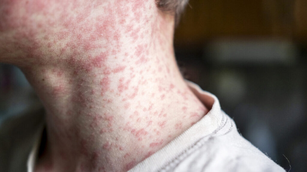 Measles outbreak investigation in Utah blocked by patient who refuses to talk Measles outbreak investigation in Utah blocked by patient who refuses to talk
